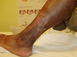 lábszárfekély gyógyulás közben