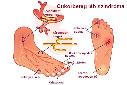cukorbeteg láb szindróma
