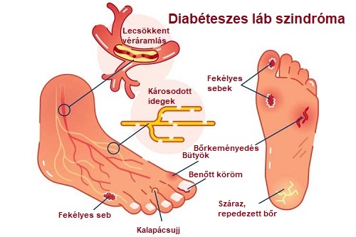 diabéteszes láb szindróma