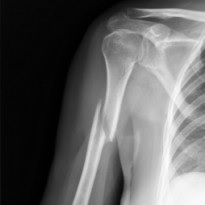felkarcsont törés röntgenképe