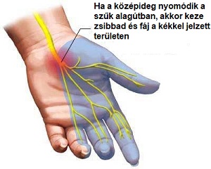 kéztőalagút szindróma oka