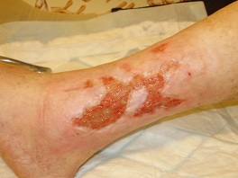 kiterjedt lábszárfekély kezelés után, már nagymértékben csökkent kiterjedésű, élő szövet felszínű sebbel