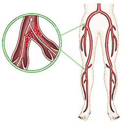 mélyvénás trombózis a lábszáron