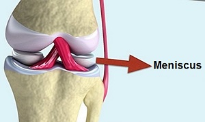 meniscus szakadása