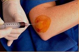 PRP injekció könyökfájdalom kezelésére