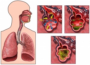 Tüdőgyulladás - a léghólyagok megtelnek gyulladásos váladékkal