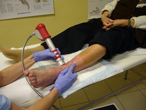 kezelés után amputáció toe diabéteszben