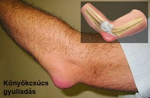 kondroitin és glükózamin túladagolása a kézkezelési fórum artrózisa