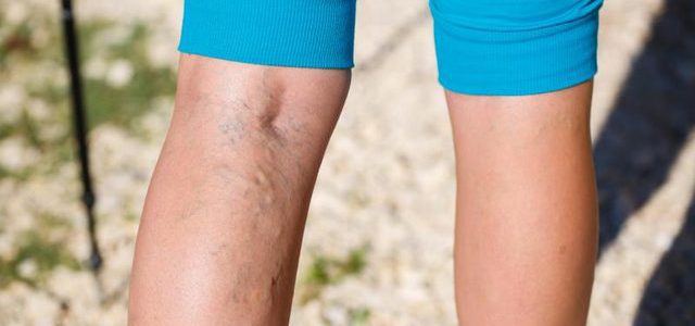 a lábakon a visszér vékony hogyan lehet enyhíteni a visszér gyulladását