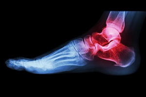 A bokaízület deformáló artrózisának stádiumai - Fájdalom a lábakban karok gerinc ízületeiben