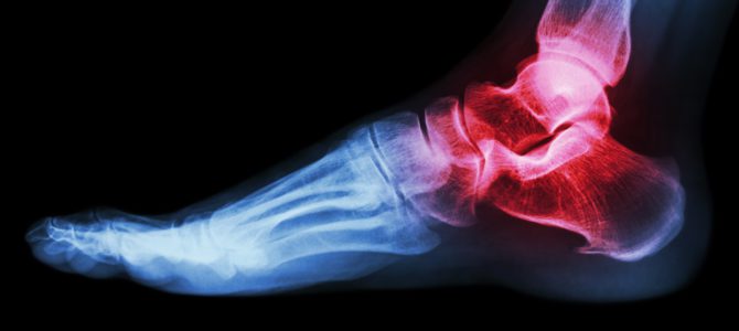 Reumatoid Artritis Hogyan lehet gyógyítani a lábízület fájdalmát
