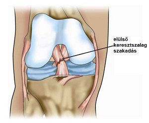 fájdalom a térd belső oldalán hajlításkor a csípőízületek osteoarthritis 2. szakasz