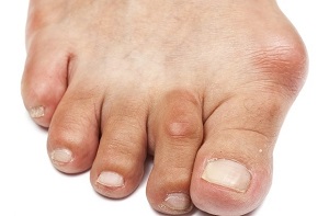 A láb farokízületének ízületi gyulladása, Reumatoid Artritis