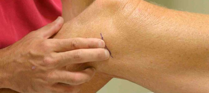 artrózis injekciós kezelés áttekintése a láb ízületeivel kapcsolatos problémák