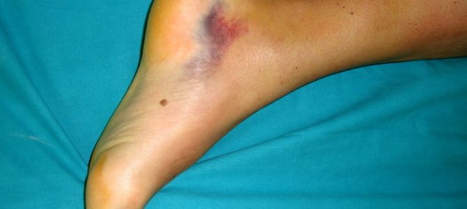 A sarok, a boka és a lábfej is fájhat Achilles-ín gyulladás miatt