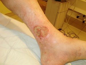Cukorbetegség: A lábfejen levő sebek veszélyesek