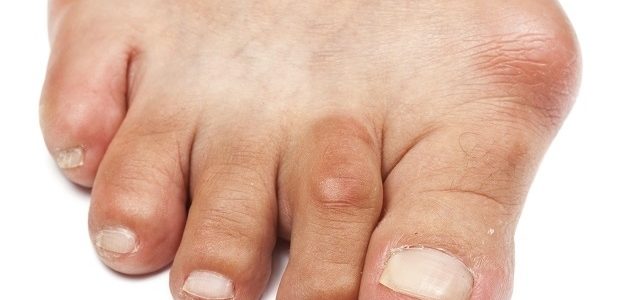 zsibbadása kéz és láb a cukorbetegség kezelésében