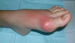 a lábízületek gyulladása okoz artrózis a térdízületek kezelésében