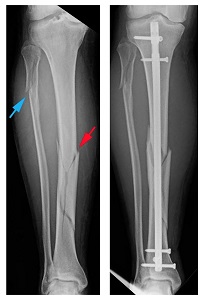 Bokaszalag sérülés: bokaszalag szakadás, Krónikus boka ligamentum sérülések kezelése