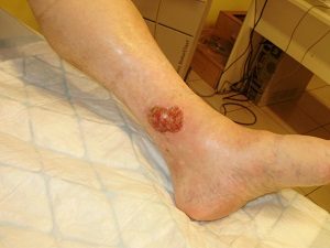gennyes sebek a lábát a cukorbetegség kezelésében)