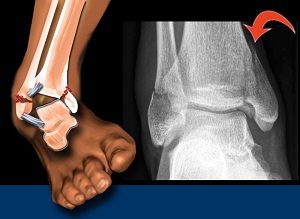 A láb sérülései - A lábközépcsontok törése
