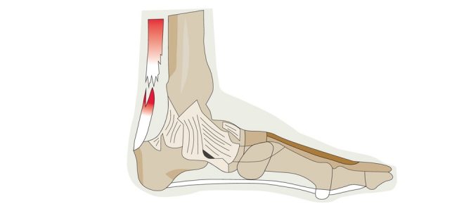 a bokaízület 1 fokozatának deformáló artrózisa