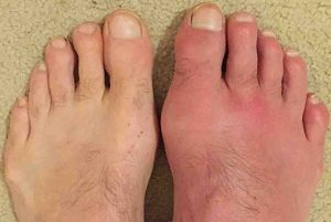 köszvénygyulladás a nagy lábujj ízületi kezelésében kenőcs az oszteokondrozis címére