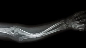 Meddig fáj a csonttörés? | Harmónia Centrum Blog