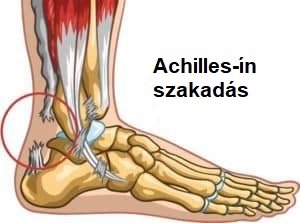 Sportsérülések – részleges Achilles-ín szakadás