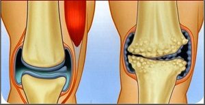 A térd 2. fokú deformált artrózisa