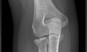 A könyökízület törése utáni gyógyulás, Osteoarthritis artrózis kezelésére