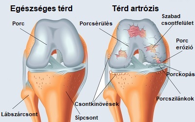a térd reumás artrózisának kezelése