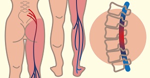 lábfájdalom a csípőben
