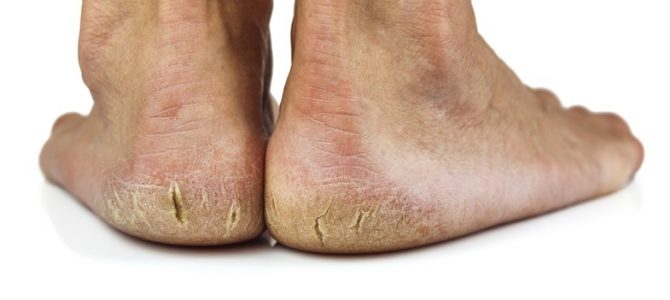Cukorbeteg láb – rettegett szövődmények
