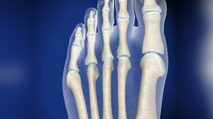 csontkinövés a lábfej külső részén