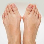 Ha a láb és a boka duzzadt - A bokaízület kezelésének 1 fokos szubluxálása otthon