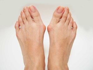 hogyan lehet kezelni a nagy lábujj artrózisát)