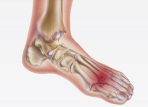 Milyen betegségekről árulkodik a láb? A bal láb kicsi ízületeinek ízületi gyulladása