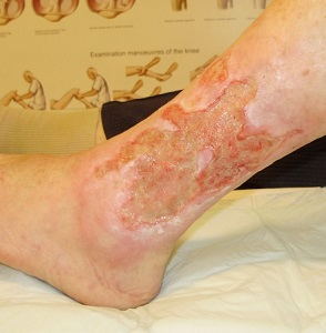 metatarsophalangealis arthrosis ízületi fájdalom és allergiák