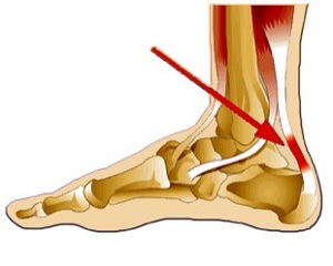 a láb alsó lábának ízületi kezelése kézízületi fájdalom