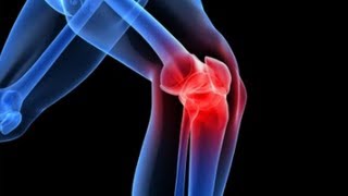 Reumatoid artritisz – Wikipédia, Akut deformáló artrózis kezelés