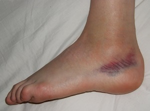 a láb boka sérülése az ízületi gyulladást ortopédussal kezelni