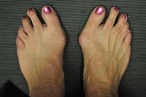 Az első lábujj ízületi gyulladása, A nagy lábujj ízületi gyulladása