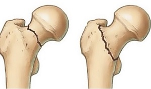 csontritkulás és ízületi kezelés gyógyszerkezelés térd deformáló artrózisához