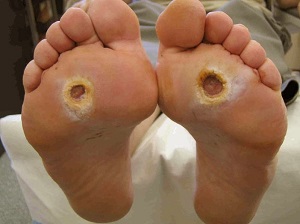 kezelése láb láb cukorbetegség)