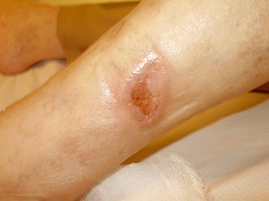 nem gyógyuló sebek a visszér lábain
