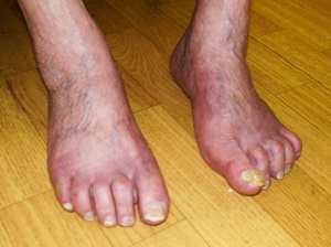 cukorbeteg láb érszükületes láb
