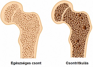 táplálkozás és kezelés artrózis és csontritkulás esetén a térdízület gonartrozisa tablettákkal történő kezelés