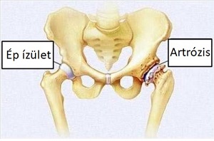 Súlyos fájdalom artrózis a csípőízület