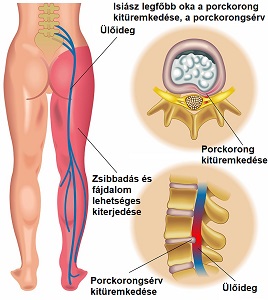 a láb artrózisának artritisz kezelése